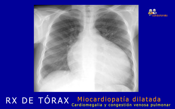 RX tórax de miocardiopatía dilatada RXtorax miocardiopatia dilatadax580 cardiofamilia.org