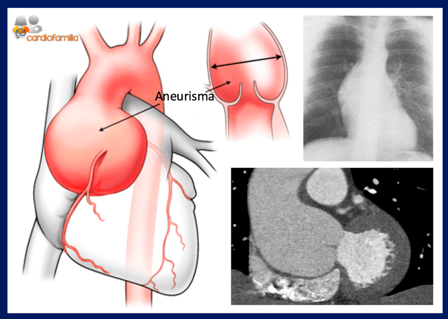 dilatacion raiz aortica cardiofamilia