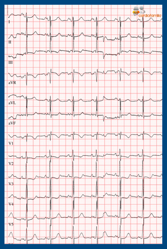 EM CAI CVD 1 cardiofamilia 1