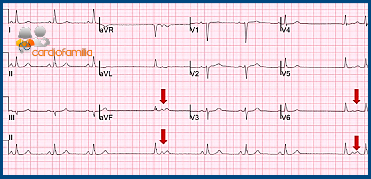 ECG CARDIOFAMILIA enf seno