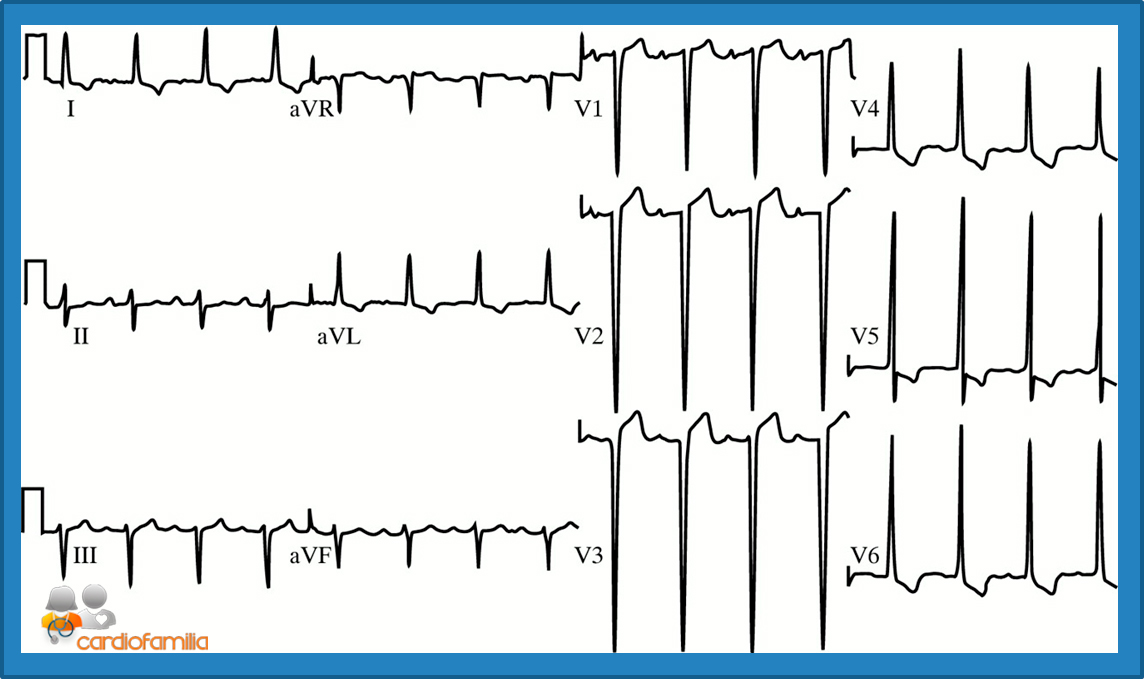 ECG 15 2018 CVI2 cardiofamilia 1