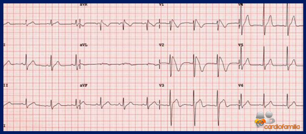 brgd cardiofamilia ecg.30.01