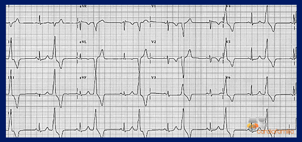 cardiofamilia ecg ed6 febrero2018