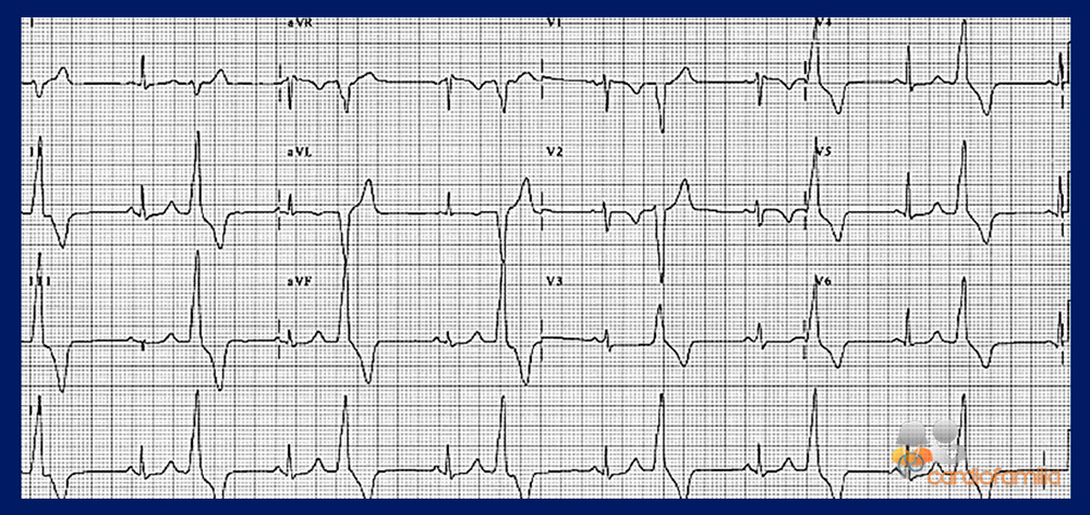 cardiofamilia ecg ed6 febrero2018