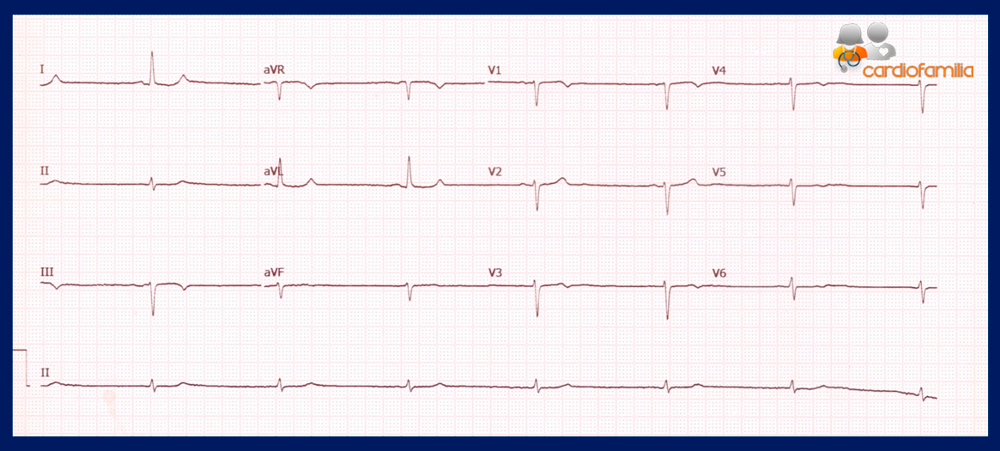 ecg brdc 19.02.2018