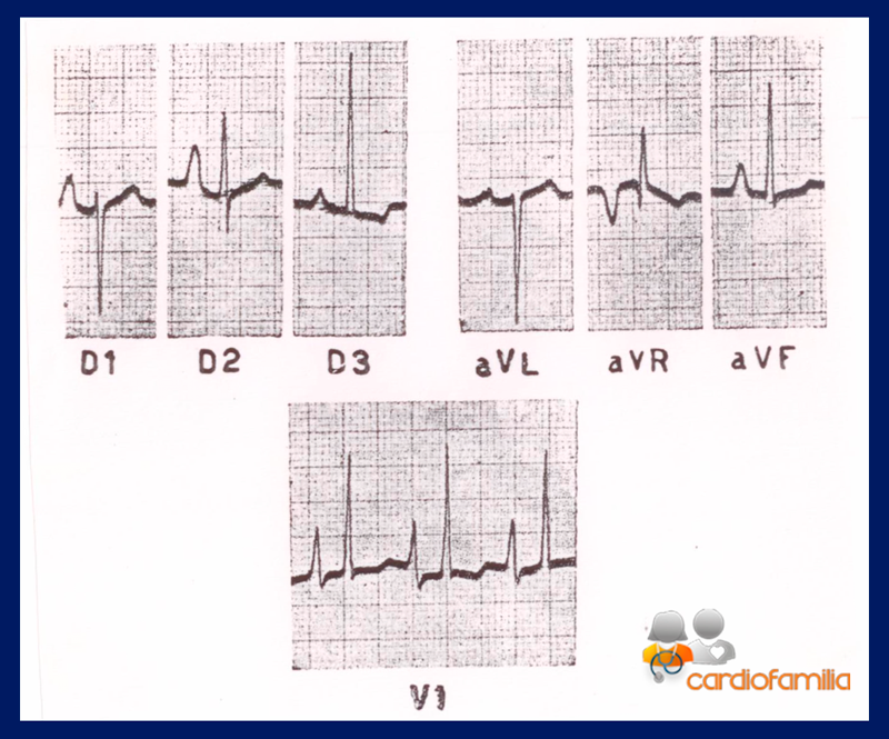 soplo sistolico eyectivo ecg cardiofamilia