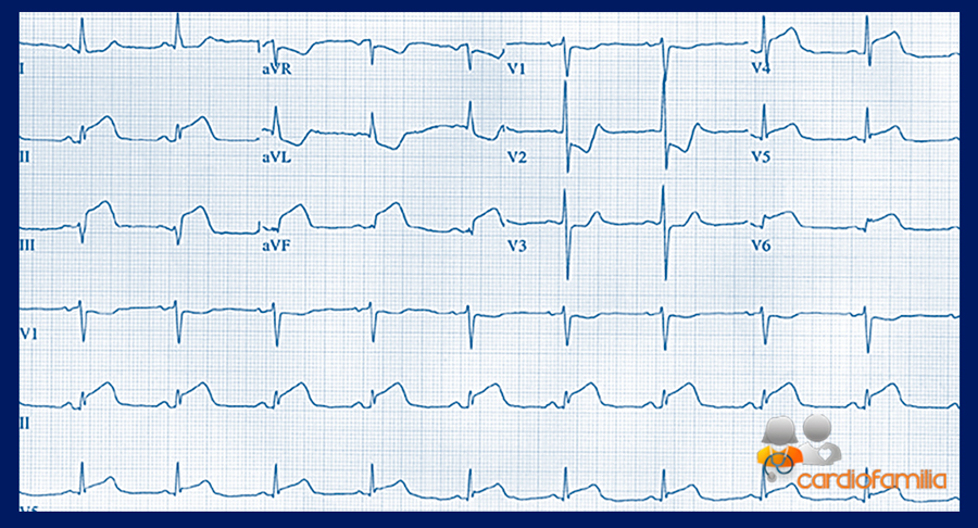 ECG enero 2019 cardiofamilia 1