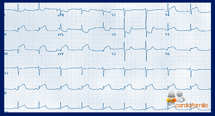 ECG enero 2019 cardiofamilia 1