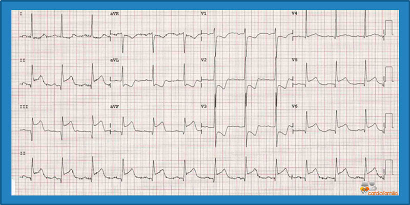 ECG marzo 2019 cardiofamilia 1