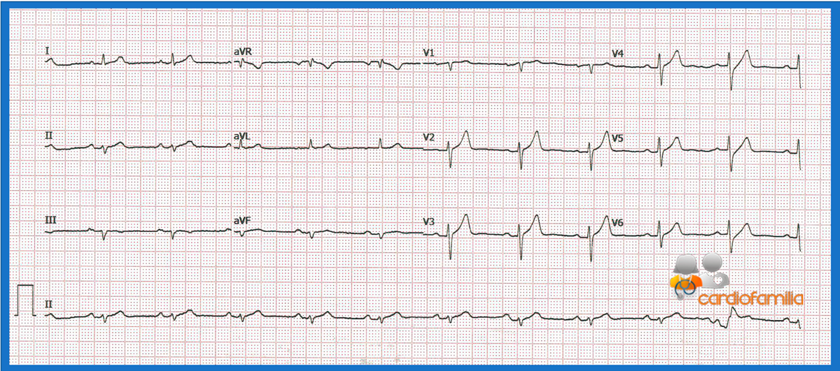 ECG 25.06.2020 cardiofamilia 1