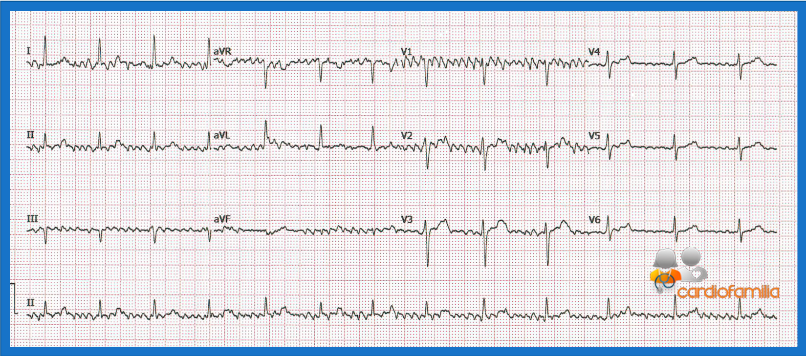 ecg cardiofamilia 11.06.2020 1 1