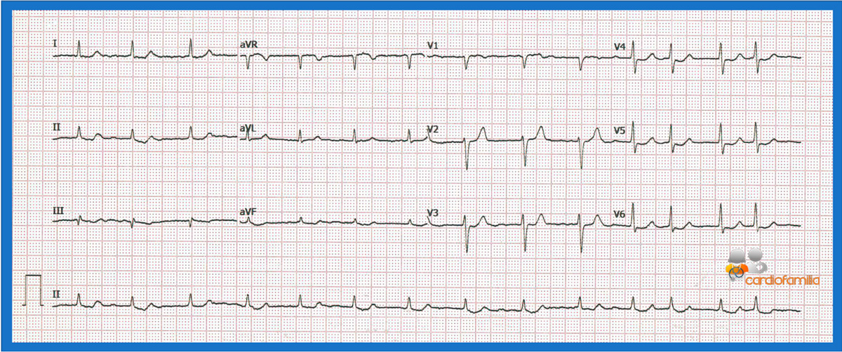 ECG 1