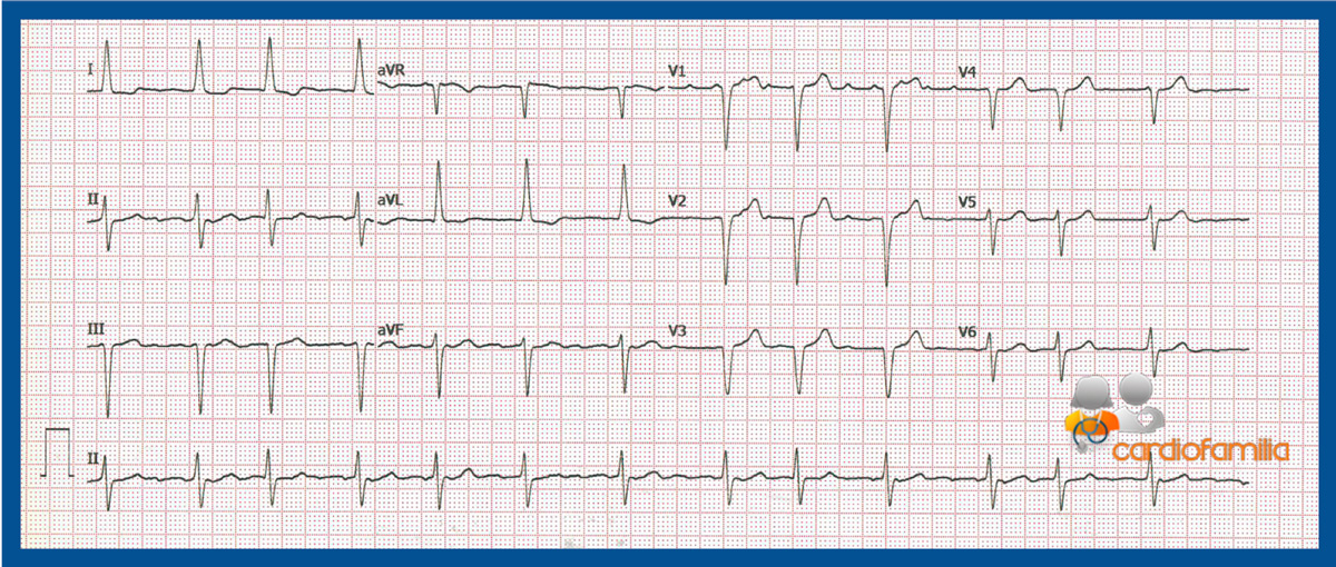 ECG 2