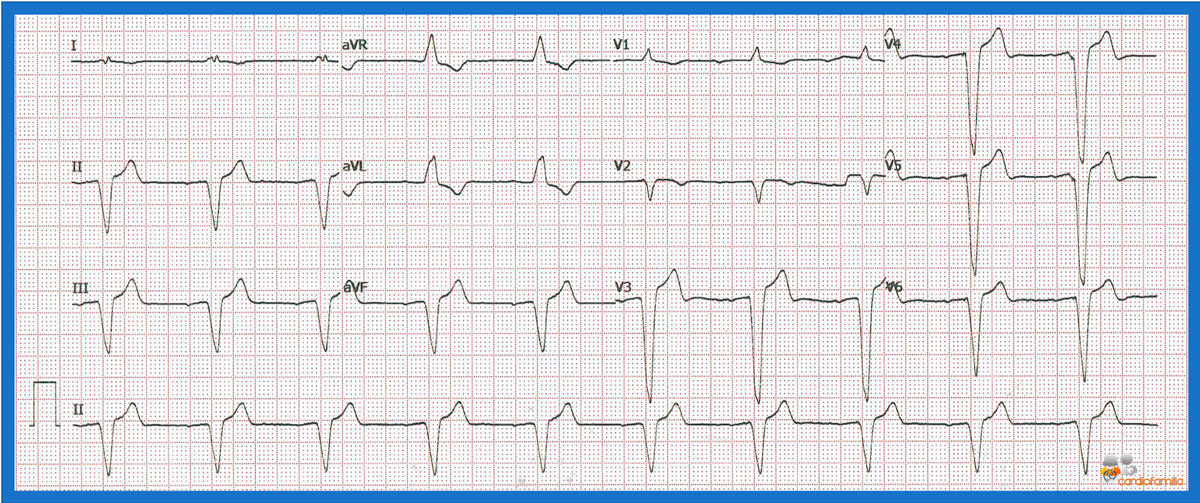 ECG 4