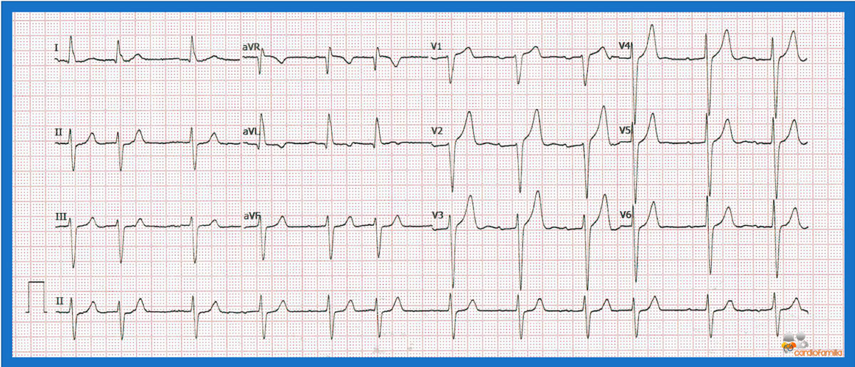 ecg5