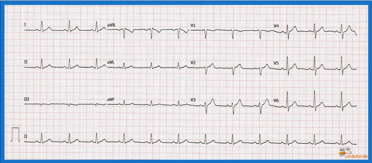 ecg6