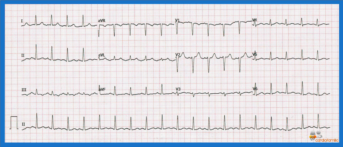 ecg7