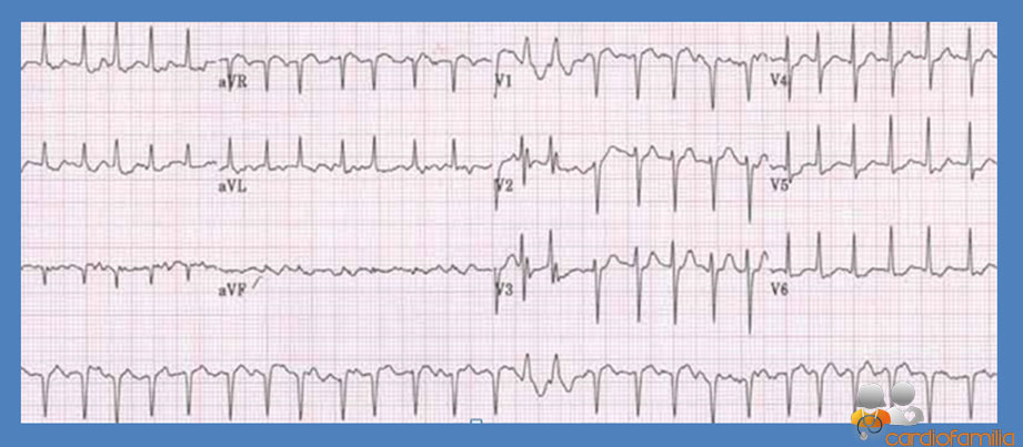 ecg26 05 2021