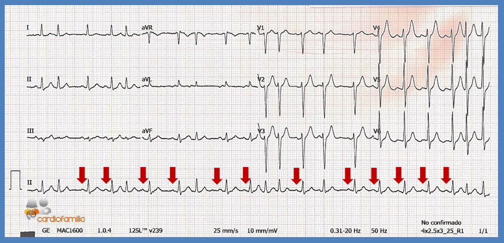 ECG cardiofamilia result