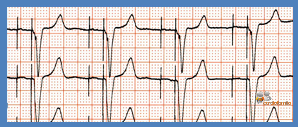 ECG ED17 Cardiofamilia