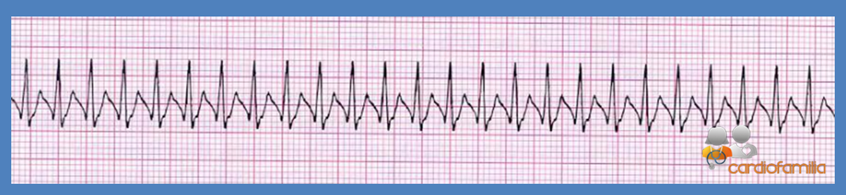 cardiofamilia 02.08.2017 ECG19