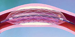 stent coronario biodegradable cardiofamilia