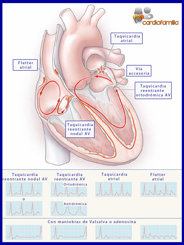 Esquema-mecanismo-y-origen-diferentes-taquicardias-supraventriculares-cardiofamilia.org