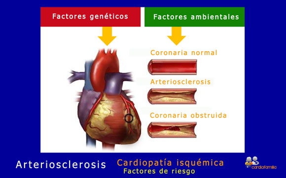 Comparativa de coronarias: coronarias normal, arteriosclerótica y obstruida Factores riesgo cardiopatia isquemicax580 www.cardiofamilia.org