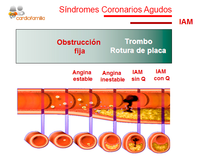 cardiopatia isquemica trombo rotura placa cardiofamilia