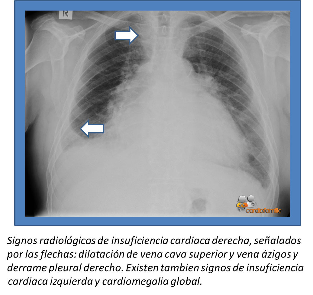 insuficiencia cardiaca derecha y derrame pleural