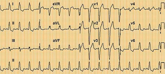 bloqueo rama izquierda ecg www.cardiofamilia.org