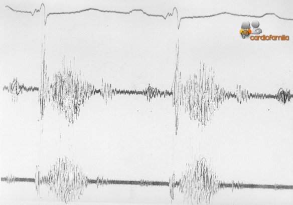 Auscultacion cardiaca mostrando cuarto ruido y foco www.sistolico cardiofamilia.org