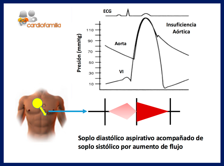 insuficiencia aortica soplo diastolico aspirativo acompañado de soplo sistolico con aumento de flujo cardiofamilia