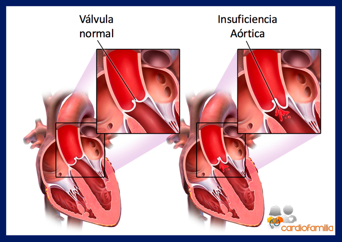 valvula normal versus valvula insuficiencia aortica cardiofamilia