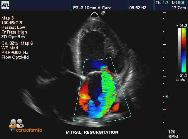 Doppler_regurgitacion_mitral_cardiofamilia.org