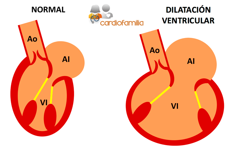 insuficiencia mitral secundaria