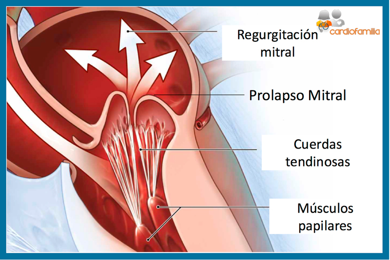 prolapso valvula mitral cardiofamilia