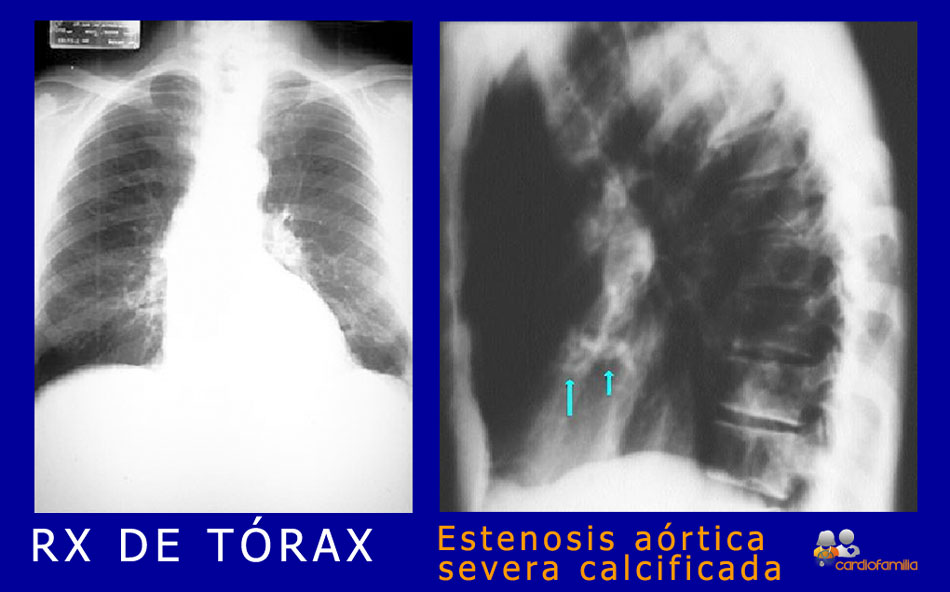 RX anteroposterior y lateral de tórax en una estenosis aórtica severa calcificada. En la AP se aprecia dilatación postestenótica del cayado aórtico. En la lateral se aprecia el calcio sobre el plano valvular, indicado con las flechas. RX_Estenosis_aortica_severa_calcificadax580_www.cardiofamilia.org