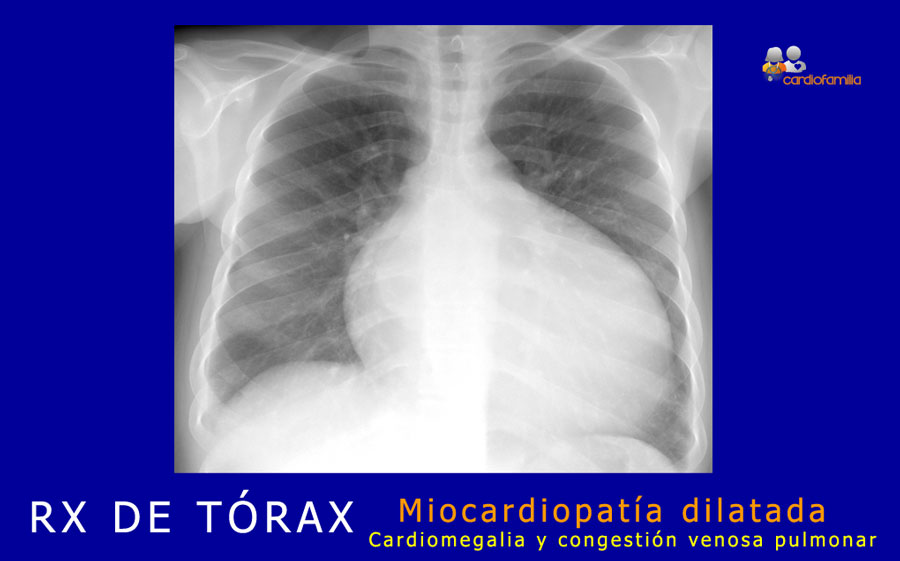 RX tórax de miocardiopatía dilatada RXtorax miocardiopatia dilatadax580 cardiofamilia.org