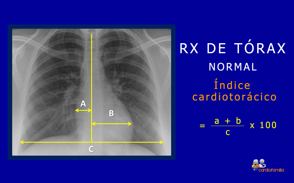 Radiografía normal de tórax. El índice cardiotorácico (A+B/C) es inferior a 0,5, esto es, al 50% RX torax normal cardiologia cardiofamilia