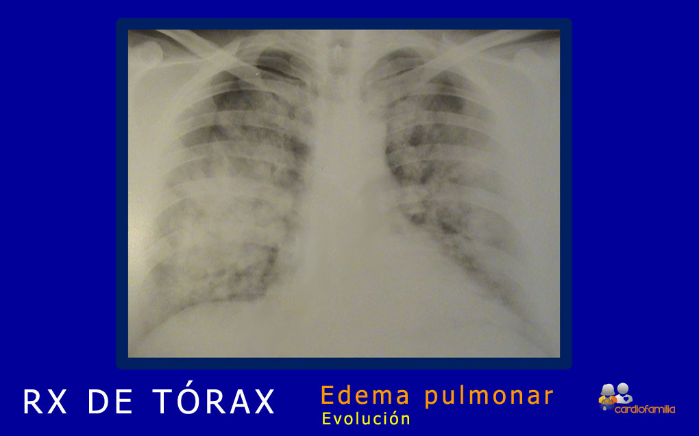 El edema agudo de pulmón se caracteriza por la presencia de imágenes densas, confluentes, mal definidas y de aspecto algodonoso, que suelen presentarse preferentemente con una distribución perihiliar. RXtorax edema agudo de pulmón