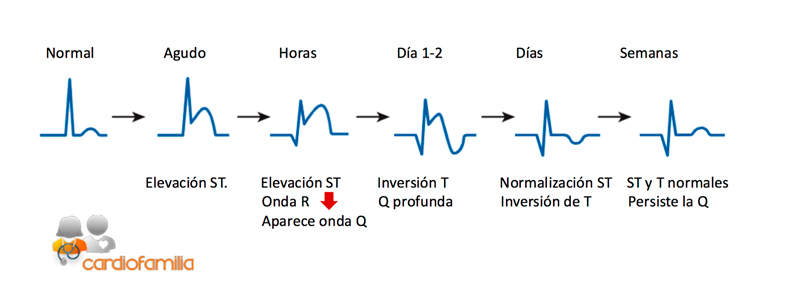 ascenso segmento ST cardiopatia isquemica cardiofamilia