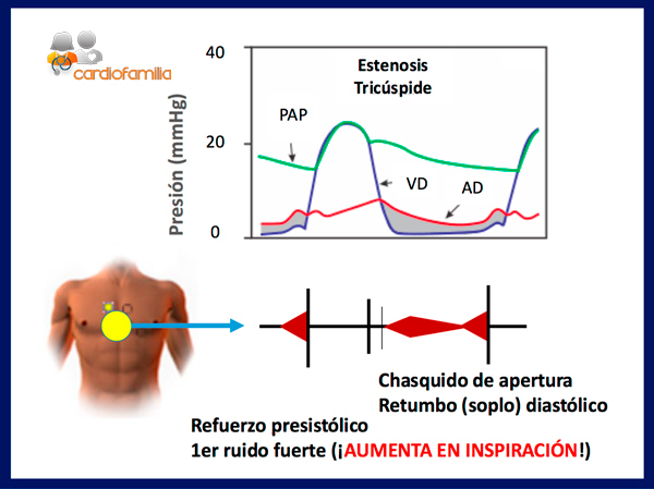 auscultacion de la estenosis tricuspide