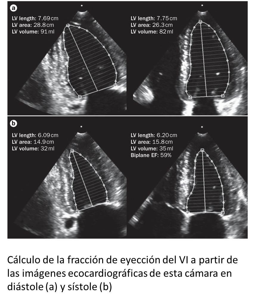 calculo fraccion de eyeccion cardiofamilia