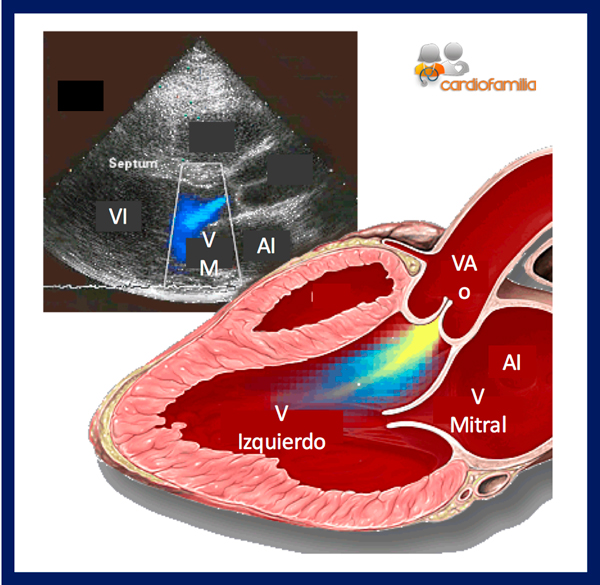 ecocardiograma deteccion chorro regurgitacion aortica cardiofamilia