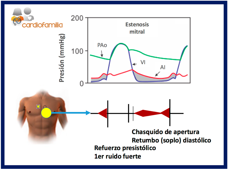 Indicadores en el proceso de auscultación de la estenosis mitral estenosis_mitral_x580_www.cardiofamilia.org