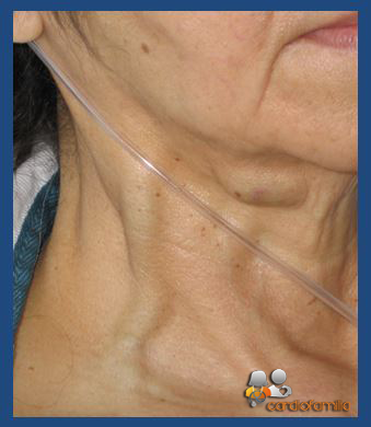 Ingurgitación yugular Ingurgitacion Yugular - Cardiologia Cardiofamilia