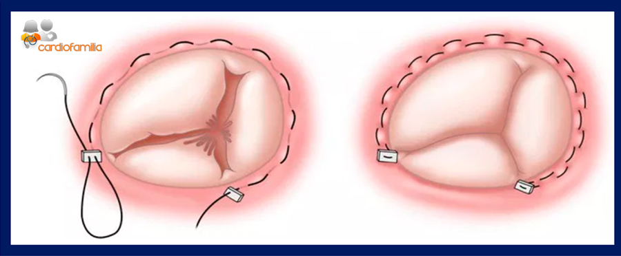reduccion anillo tricuspideo cardiofamila