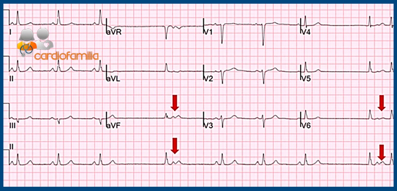 ECG CARDIOFAMILIA enf seno