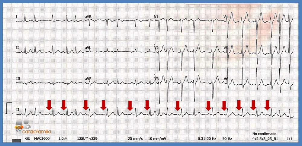 ECG febrero 2017 result
